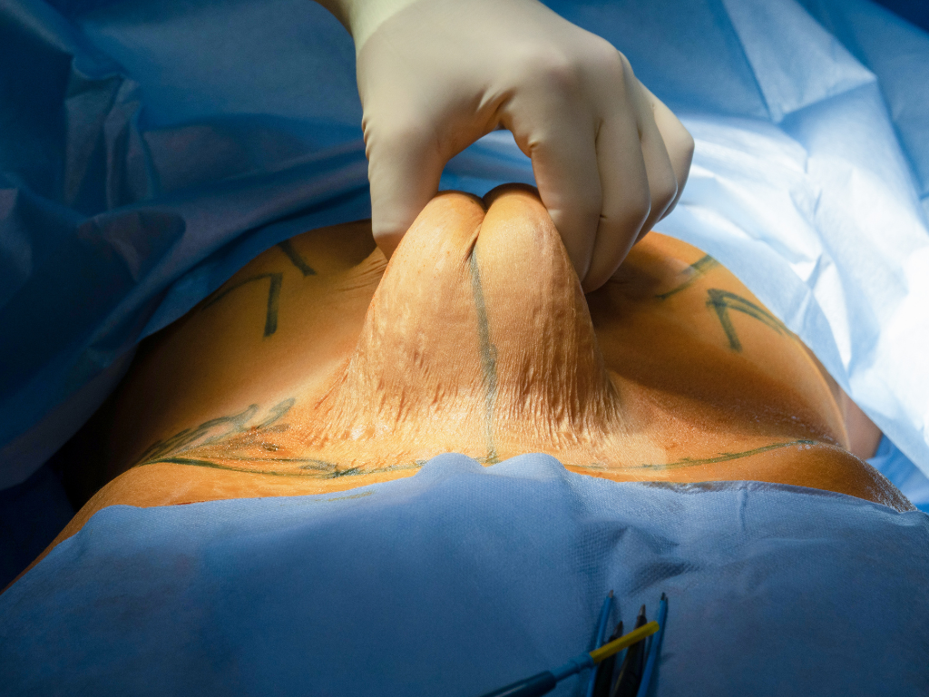 Abdominoplastika